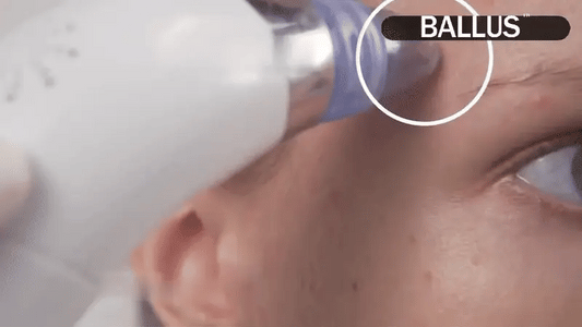 DermaSuction Face Pore Cleansing Beauty Instrument